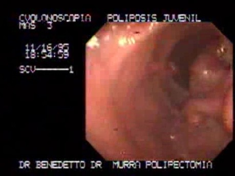 Non Familial Juvenile Polyposis Of The Colon (10 of 37)
