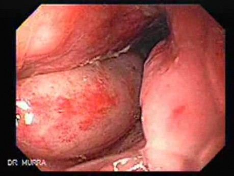 Gastroesophagic Varices - 66 - Year - Old Man (1 of 7) 