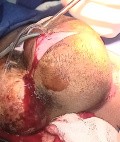 Meningocele in an 18-year-old patient