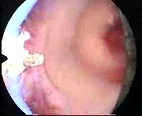 Hysteroscopic Treatment Of Intrauterine Synechia