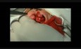 Chiloplasty by Limberg