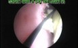 PCNL - Pig Tail Ureteric Stent