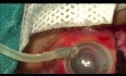 Use of Anterior Chamber Maintainer in Management of Open Globe