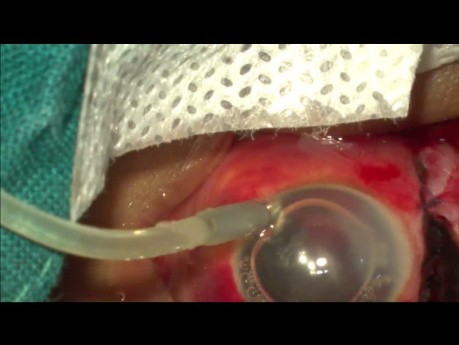 Use of Anterior Chamber Maintainer in Management of Open Globe