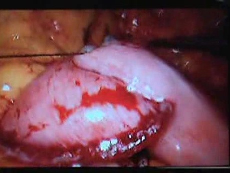 Jejunal Gastrointestinal Stromal tumor (GIST) (35 of 86)