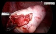 How to Perform Safe Dermoid Ovarian Cystectomy without Spillage