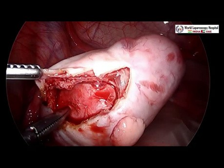How to Perform Safe Dermoid Ovarian Cystectomy without Spillage