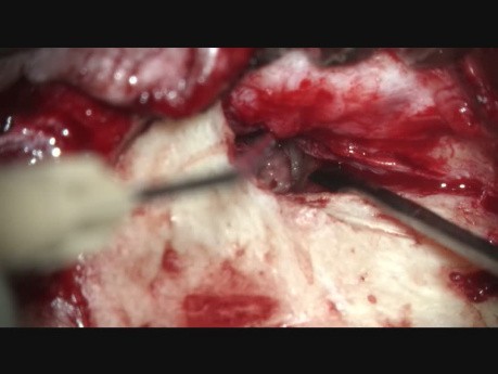 Tympanoplasty by Pr. P. Dolhen