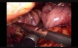 Clip Jam During Sleeve Gastrectomy