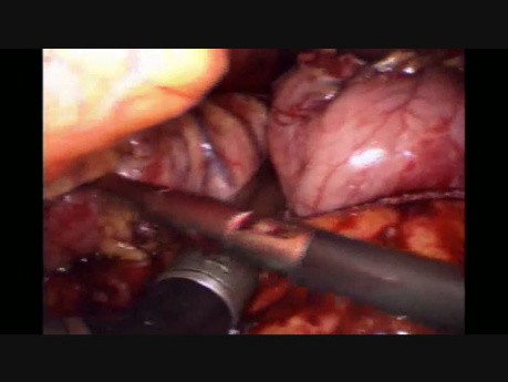 Clip Jam During Sleeve Gastrectomy