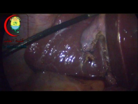 Where to Apply Your Clip or Ligature in Lap Cholecystectomy