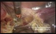 Surpacervical Hysterectomy in 15 mn (Full edition) 