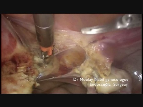 Surpacervical Hysterectomy in 15 mn (Full edition) 