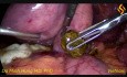 Laparoscopic Cholecystectomy, Choledochoscopy and Extraction of Common Bile Duct Stones