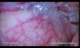Laparoscopic Repair of Inguinal Hernia: TAPP. A Step by Step Description.