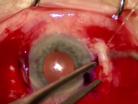25G Pars Plana Vitrectomy + Soleko Carlevale IOL Implantation Using the "Scleral Pocket" Technique