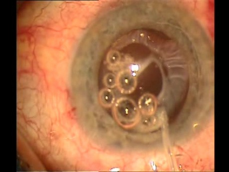 Surgical management of Capsule Contraction Syndrome - case 2