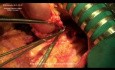 Spleen-preserving radical GASTRECTOMY with D2 lymphadenectomy