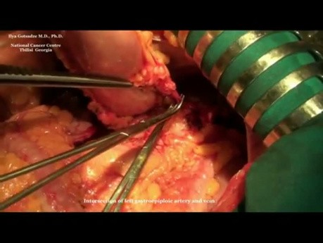 Spleen-preserving radical GASTRECTOMY with D2 lymphadenectomy