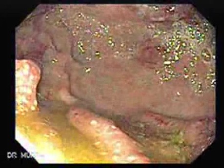 Ovarian Carcinoma with Gastric and Duodenal Metastases - Thickening of the Duodenal Walls