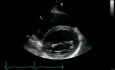 Parasternal View At The Level Of The Mitral Valve  Normal Study
