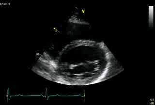 Parasternal View At The Level Of The Mitral Valve  Normal Study