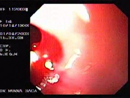 Variceal Bleeding - Typical Case