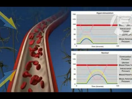 Effects of Uterine Hyperstimulation on Cerebral Circulation