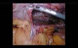 Laparoscopic Repair of Large Diaphragmatic Hernia