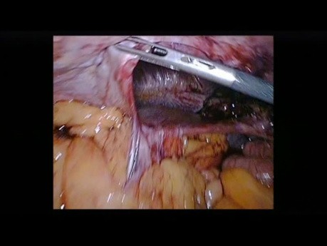 Laparoscopic Repair of Large Diaphragmatic Hernia