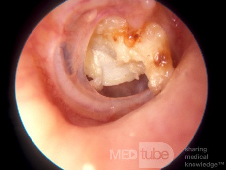 Cholesteatoma Pouring Out Of Subtotal Perforation