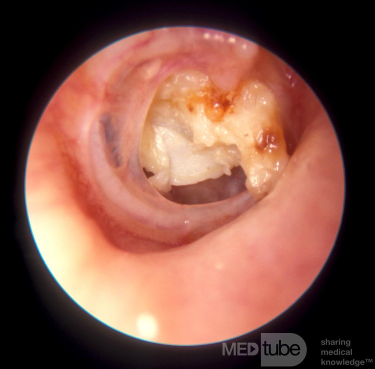 Cholesteatoma Pouring Out Of Subtotal Perforation