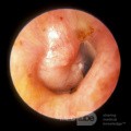 Primary Adenoma of the Middle Ear