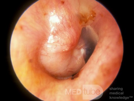 Primary Adenoma of the Middle Ear