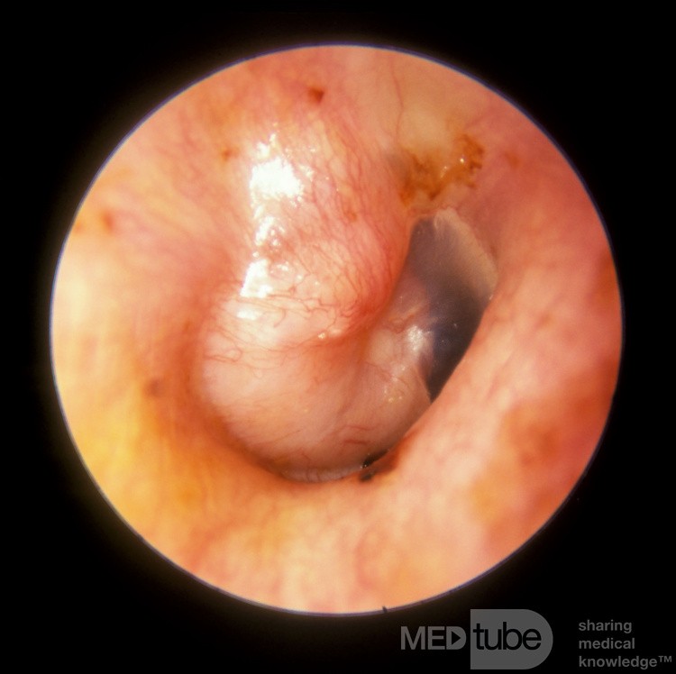 Primary Adenoma of the Middle Ear