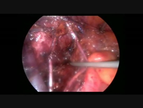 Obturator Nerve Injury During TLRH