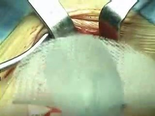 PHS- femoral hernia repair