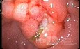 Gastroscopy - MALT Lymphoma