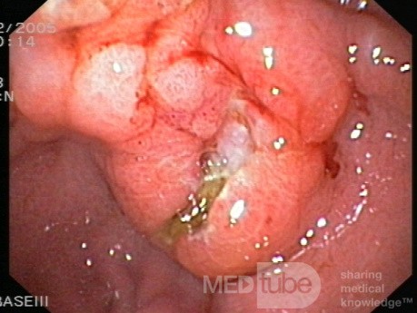 Gastroscopy - MALT Lymphoma