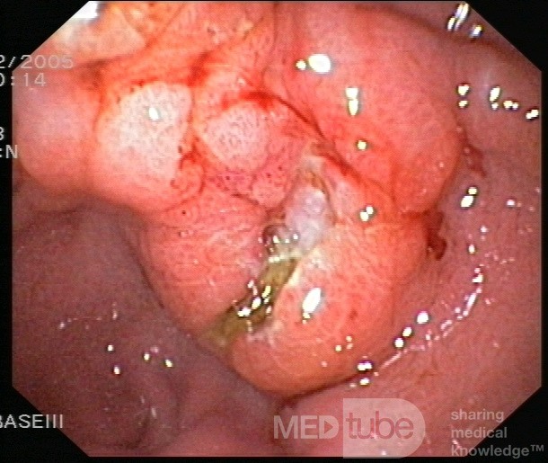 Gastroscopy - MALT Lymphoma