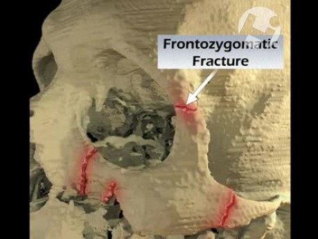 Facial Fractures