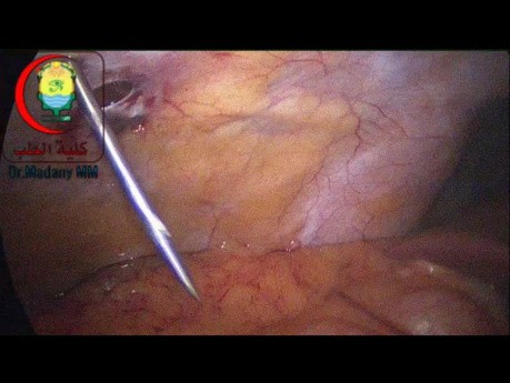 Nasr Fascial Closure Device