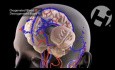 Cerebral Venous Sinus Thrombosis