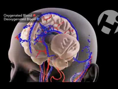 Cerebral Venous Sinus Thrombosis