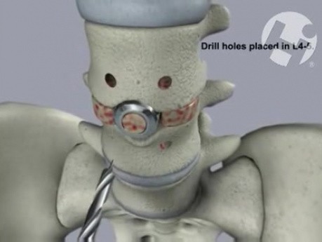 L4-5 Posterolateral Fusion