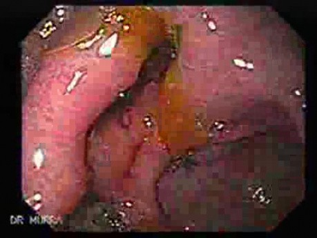 Peptic Ulcer And Liver Cirrhosis (1 of 5)