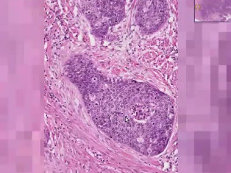 Squamous cell carcinoma - Histopathology - Cervix
