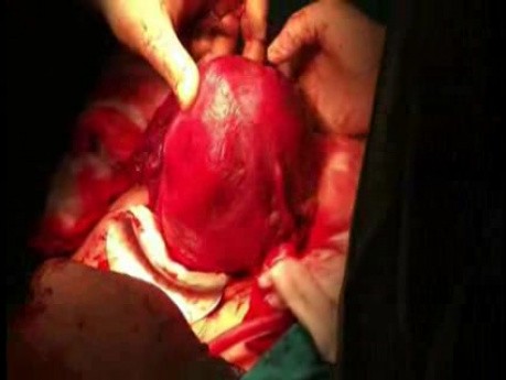 Tubal ligation