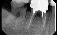 S-shaped Canals Glide Path and Instrumentation with Tactile Controlled Activation Technique