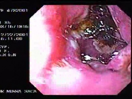 Duodenal Ulcers and Erosions (1 of 3)